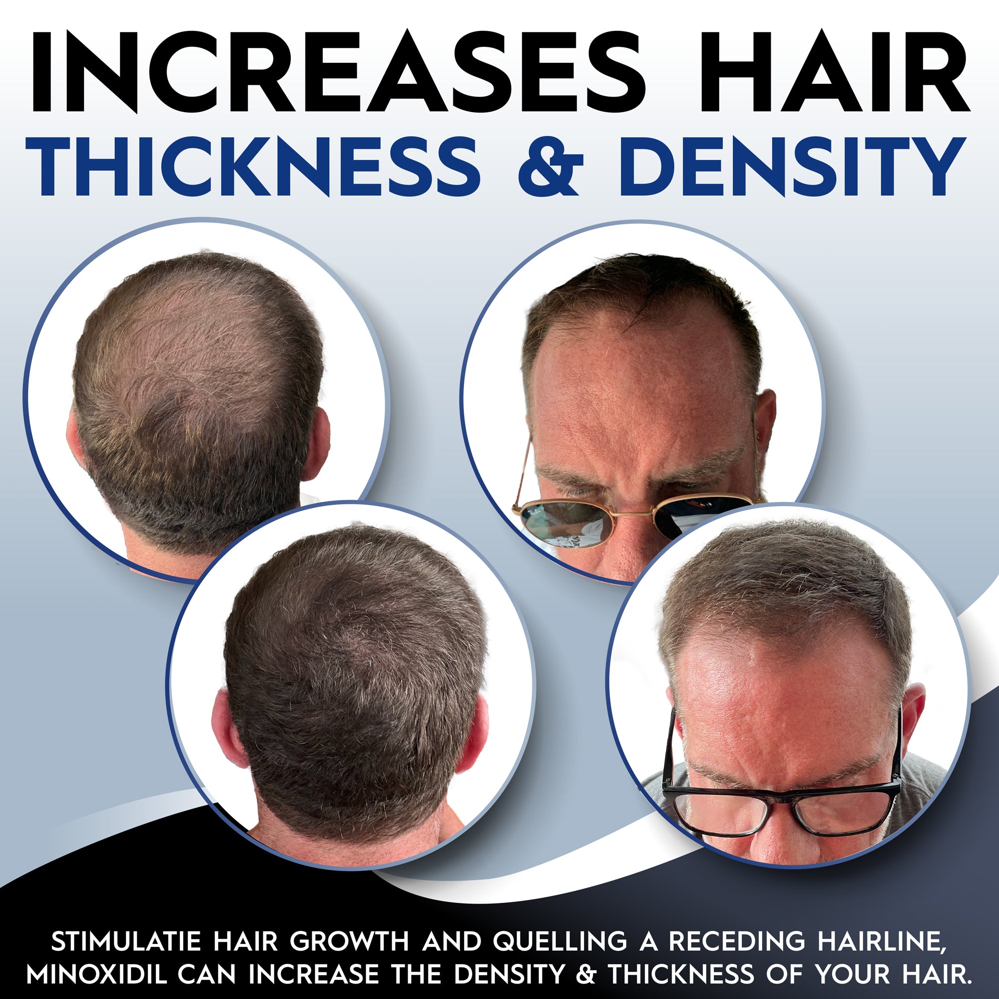 Minoxidil (Rogaine) 5% Men's Hair Regrowth Foam